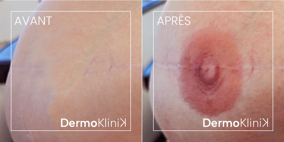Drrmopigmentation aréole mammaire Lille Marcq en Baroeul Villeneuve d'Ascq